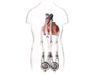 Esquema del sistema EXCOR Pediátrico de Berlin Heart implantado, con cánulas conectadas al corazón y bombas de sangre paracorpóreas